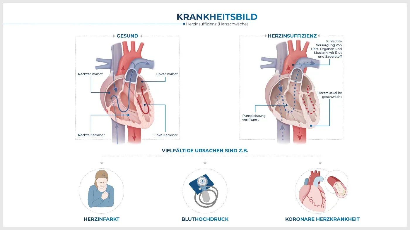Illustration Herzinsuffizienz aus Explicare